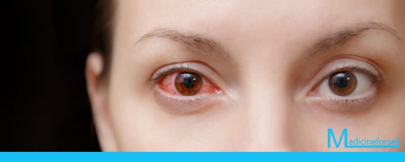 حساسية العين: أنواع عديدة وعلاجات مختلفة