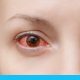 حساسية العين: أنواع عديدة وعلاجات مختلفة