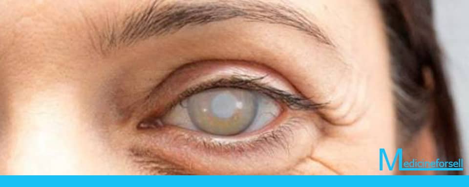 هل يمكن علاج إعتام عدسة العين طبيعيًا؟؟