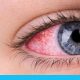 علاج احمرار العين بالمنزل