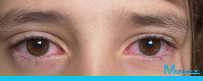 إحمرار العين عند الأطفال