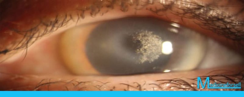 ضمور القرنية في العين مع أعراض محددة