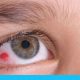 أعراض سرطان العين وأهم المعلومات حوله