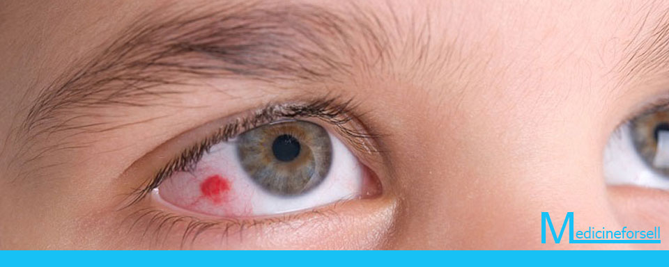 أعراض سرطان العين وأهم المعلومات حوله