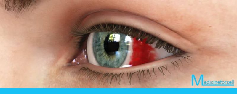 نزف تحت الملتحمة (وعاء دموي مكسور في العين): الأعراض, التشخيص والعلاج