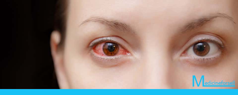 علاج تهيج العين طبيعيا