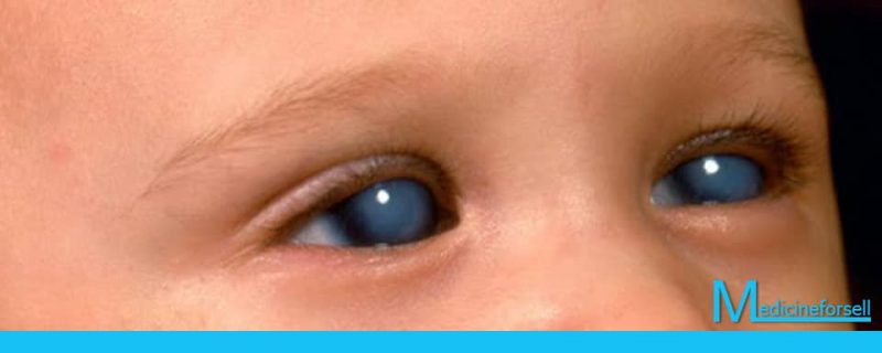 الجلوكوما الخلقية: المياه الزرقاء عند الأطفال + علاجات