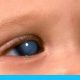 الجلوكوما الخلقية: المياه الزرقاء عند الأطفال + علاجات