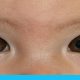 أسباب انحراف العين عند الأطفال
