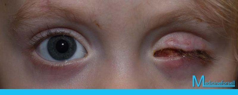 ما هي عملية استئصال العين؟