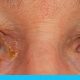 العيون اللَّزِقة - إفرازات العين
