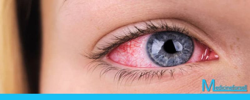 ما هو علاج التهاب العين من العدسات