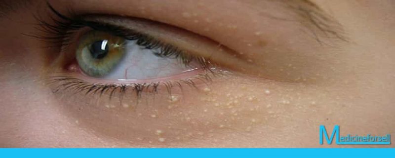 بقع بيضاء تحت العين: أسباب وعلاج الحبوب الدهنية البيضاء تحت العين