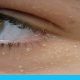 بقع بيضاء تحت العين: أسباب وعلاج الحبوب الدهنية البيضاء تحت العين