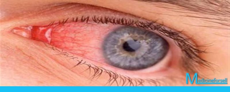 احمرار العين: متى يصبح علامة خطر وكيف يمكن تجنبه؟