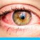أسباب احمرار العين عند الأطفال