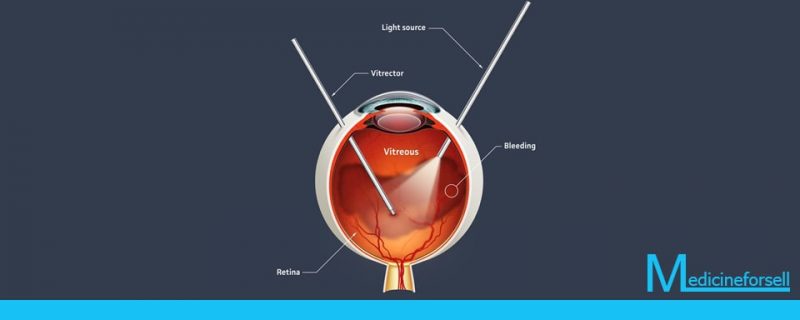 عملية استئصال زجاجية العين