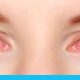 الأعراض حساسية العين