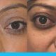 علاج جحوظ العين