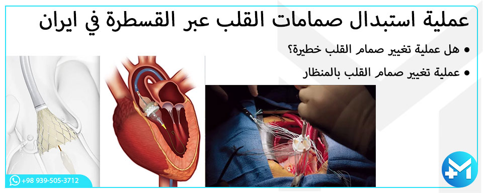 عملية استبدال صمامات القلب عبر القسطرة في ايران